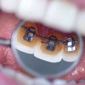 traitements orthodontie : de jeunes patients et leurs parents témoignent
