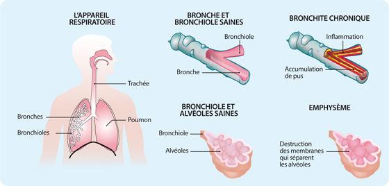 BPCO_01_cnamts, broncho-pneumopathie chronique obstructive