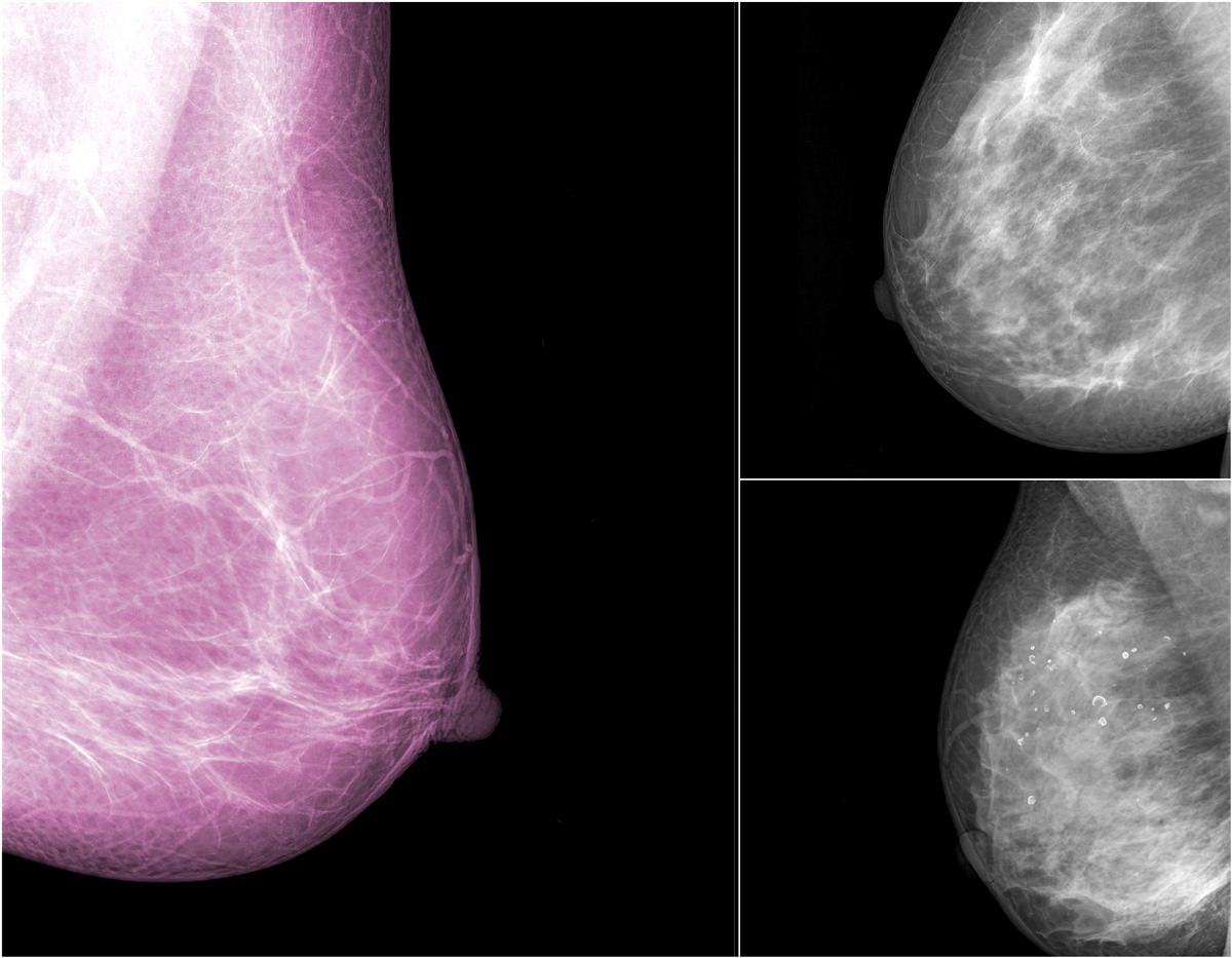 mammographie cancer du sein