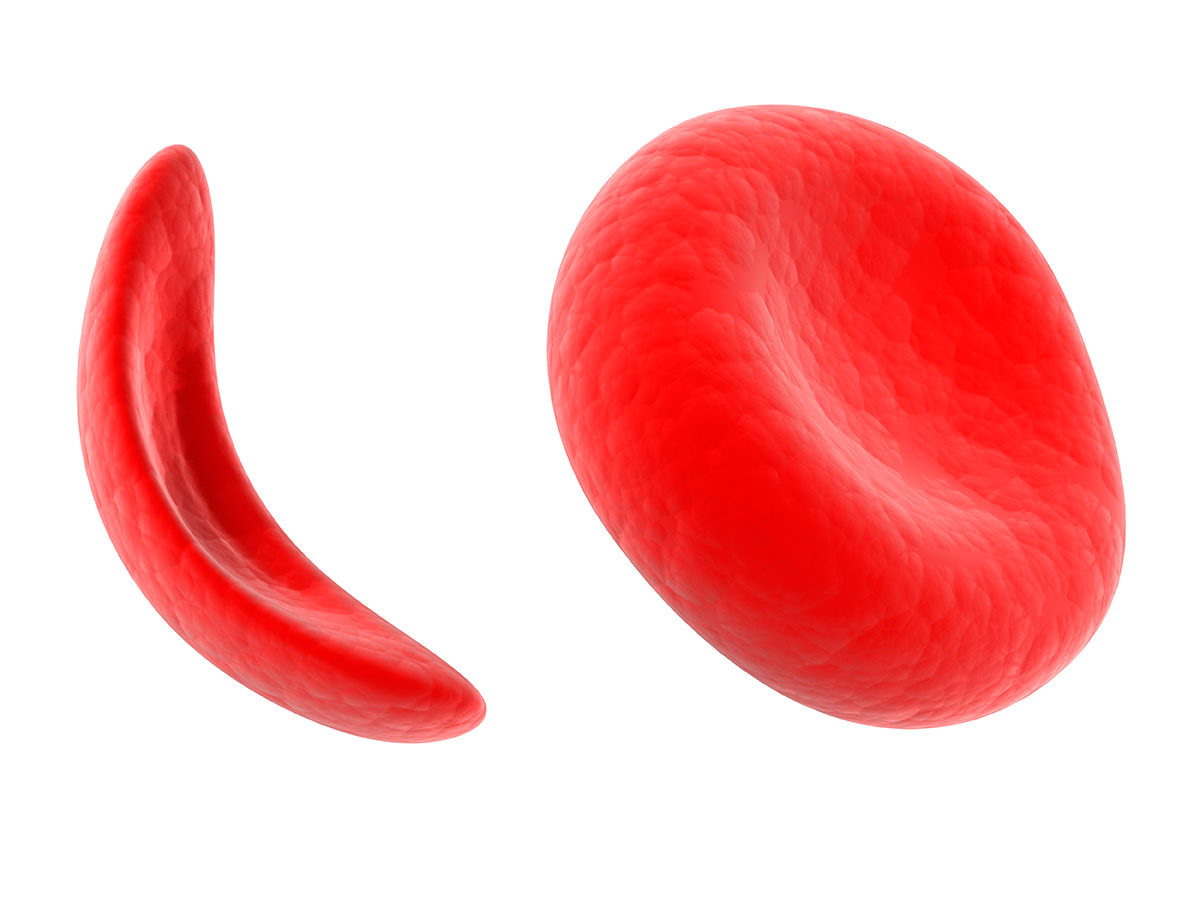 Drépanocytose : une maladie génétique du sang