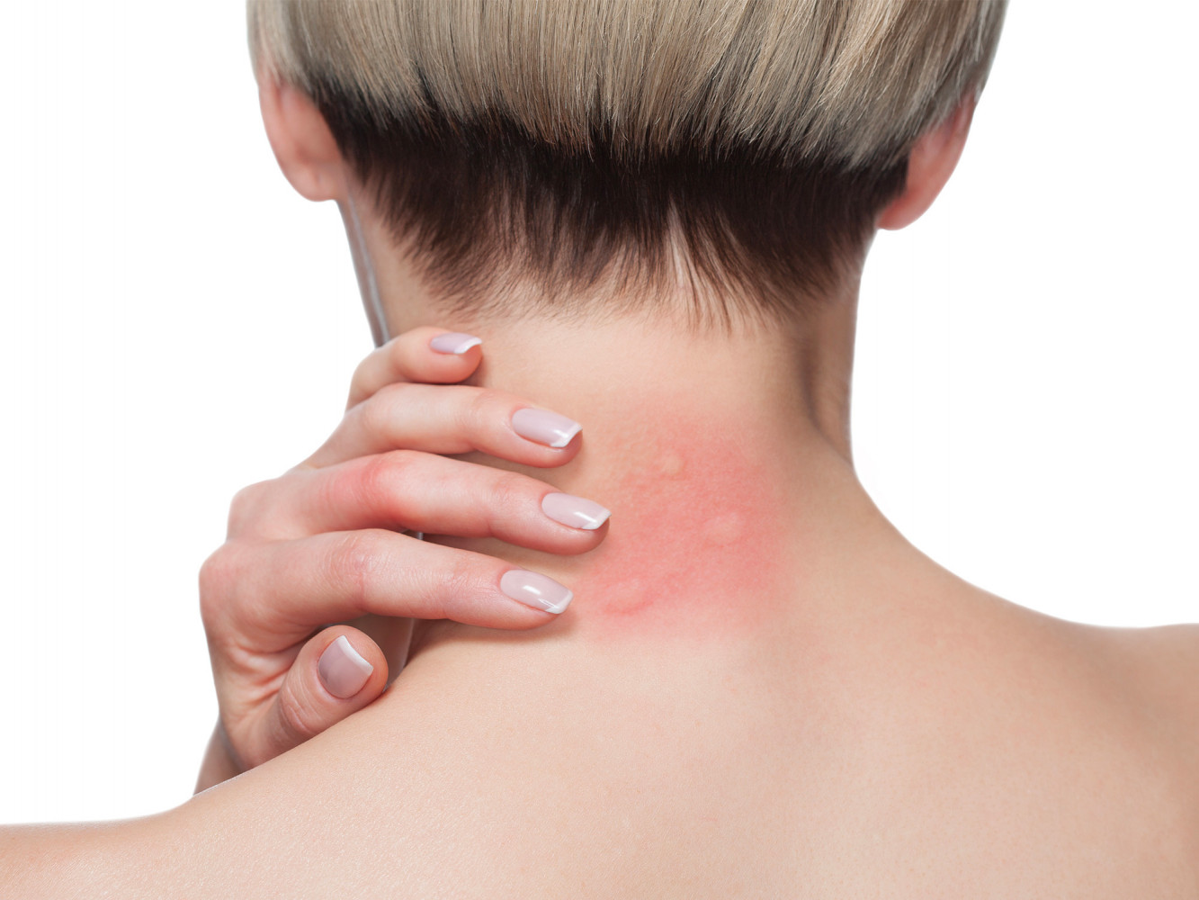 Que faire en cas de piqûre de guêpe