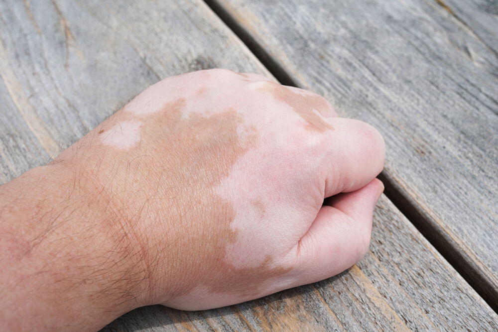 Détecter le vitiligo, une maladie de la peau